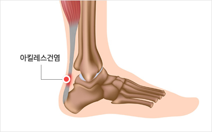 아킬레스건(Achilles tendon) 수술 관련 이슈 보도